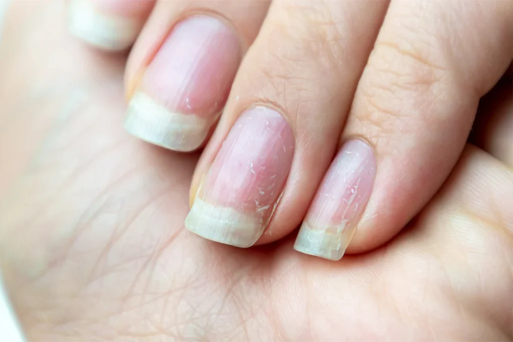 Gel Nails vs Acrylic Nails in 2025 – Which One Should You Choose? 7 Brittle Nails