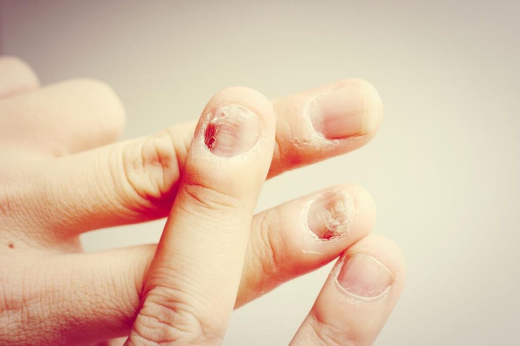 How to Take Care of Your Nails Naturally at Home in 2025 7 a nail with onychomycosis flaking and cracking are some of the more common symptoms