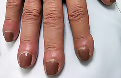How to Take Care of Your Nails Naturally at Home in 2025 15 clubbing curved nails