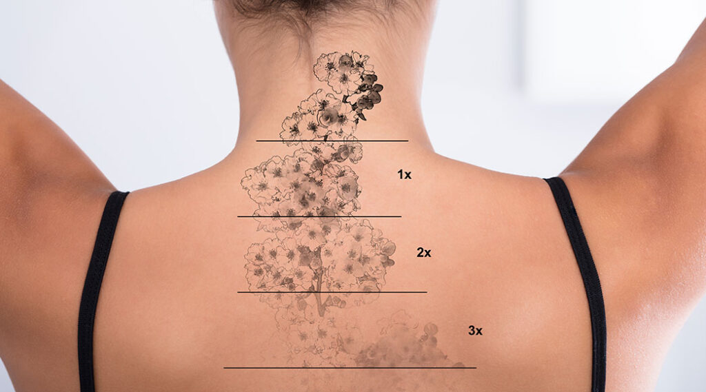 Cover-Up Tattoos 2025 – How to Transform Old or Unwanted Ink 5 how to speed up tattoo removal and fading