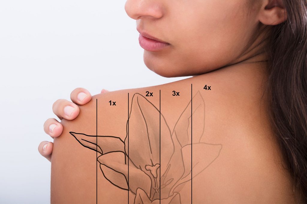 Tattoo Myths Busted: Separating Fact from Fiction 2 levels of tattoo removal 1024x683 1